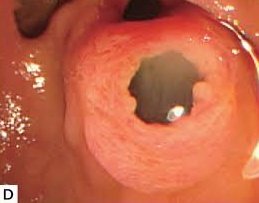 almagoch's tweet photo. Un papila en "boca de pescado". Se considera un hallazgo patognomónico de la neoplasia papilar mucinosa intraductal o #ipmn 
#Cirugía #Cirujanos https://t.co/tfkqntfBLM