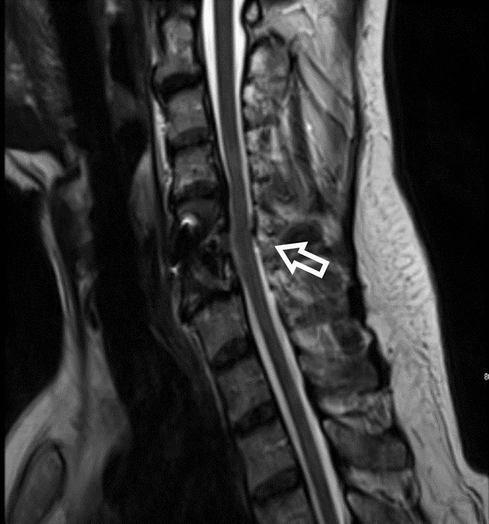Cervical Spinal Cord Ischemic Reperfusion Injury: A Comprehensive Narrative Review of the Literature and Case Presentation <a href="/gahtaniay/">Abdulhadi Algahtani | عبدالهادي القحطاني</a>
l8r.it/6TMK
#neurosurgery #neurosurgeon #medtwitter #meded
