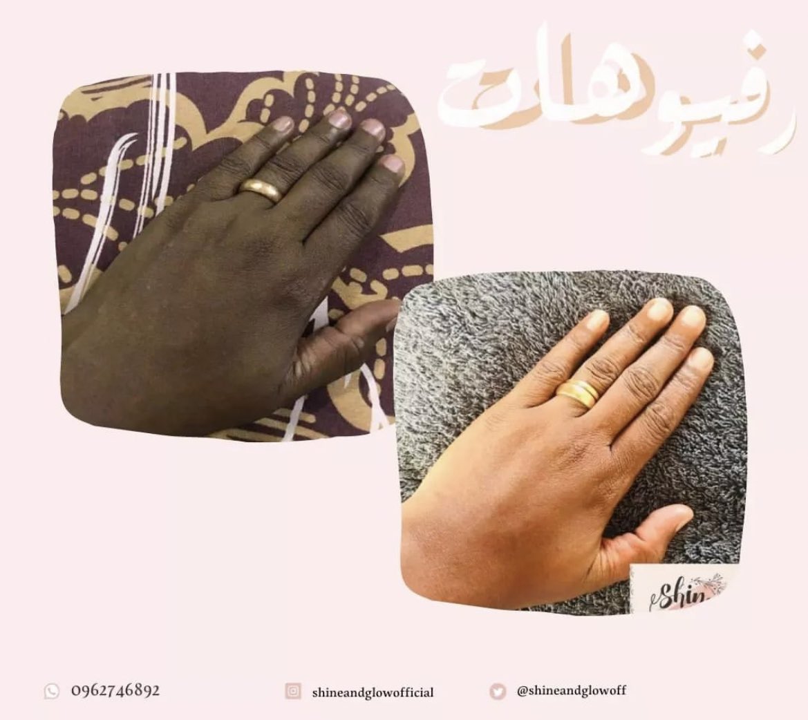 shineandglowcos's tweet photo. سحب على كريم الجسم " كريستال بودي"

تفتيح، ترطيب عميق، توحيد لون الجسم بالكامل، ازالة اثار الجسم و الجروح و الضربات مع الاستمرار، نضارة نضااارة نضارة و بشرة مشرقة جدا 😍🔥

الشروط:

ريتويت
فولو للاكاونت
منشن لي صحبتك
ختي لينا ♥️ في كومنت

لو ردينا عليك ب ♥️ انتي الفايزة معانا ♥️ https://t.co/ndl5rH06sw