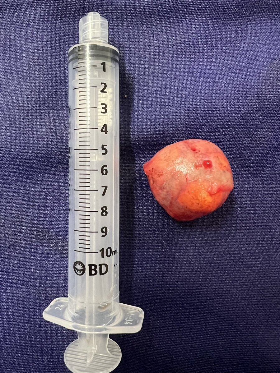 VcntKno's tweet photo. Two #Zeroischemia #Laparoscopic #Enucleation from today and yesterday. Both as a discover w/o symptoms. #UroSoMe #Urology #oncology

😷The importance of yearly check-ups

@so_uro @colmexuro @smumexico @Uroweb @CAU_URO https://t.co/WD1BbGaOwC