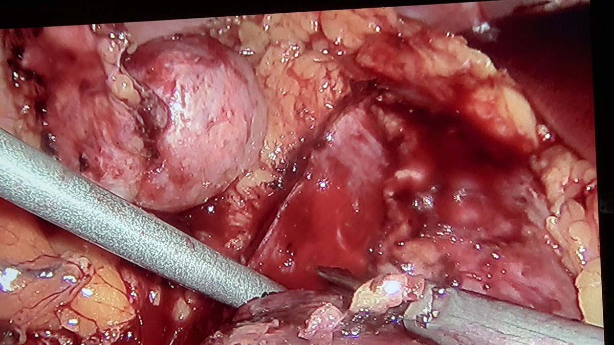 VcntKno's tweet photo. Two #Zeroischemia #Laparoscopic #Enucleation from today and yesterday. Both as a discover w/o symptoms. #UroSoMe #Urology #oncology

😷The importance of yearly check-ups

@so_uro @colmexuro @smumexico @Uroweb @CAU_URO https://t.co/WD1BbGaOwC