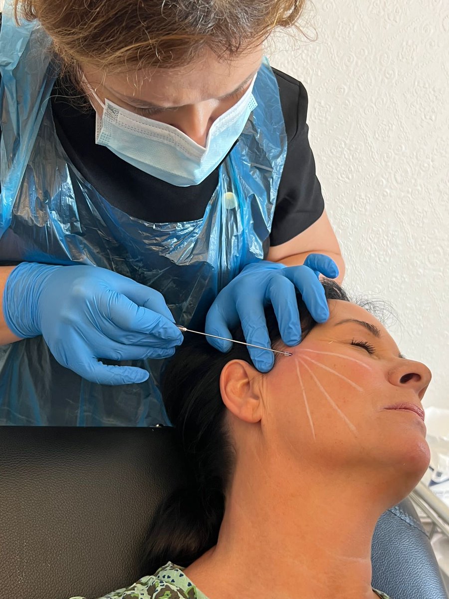 Aesthe1Complete's tweet photo. #PDO #threads #non #surgical #face #lift at my #aylesbury #clinic #aesthetic https://t.co/gt508xzKlC