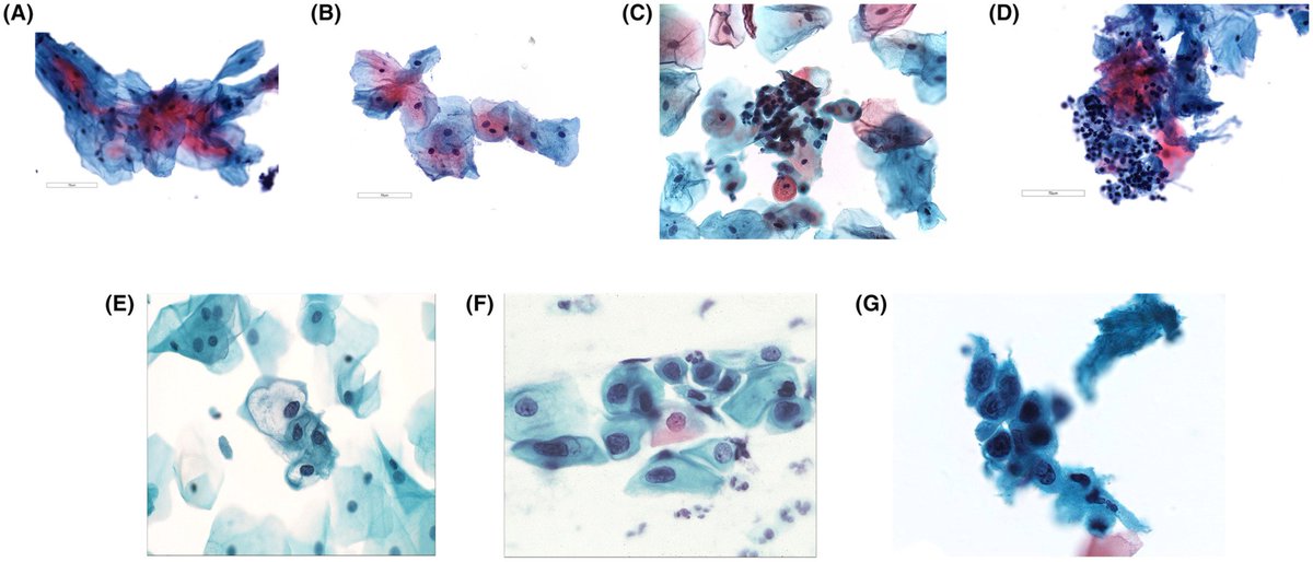 Cancer Cytopathology on Twitter "Findings support oral liquidbased