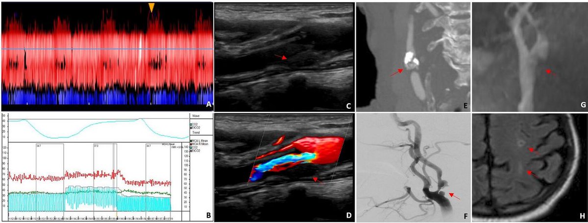 Juan Carlos Martinez Gutierrez MD (@jcmartinezmd) on Twitter photo Consider sharing our review on asymptomatic carotid stenosis and updated evidence for high risk features. Thanks to <a href="/s_hyunwookim/">Hyun Woo (Steve) Kim</a> for leading the effort. <a href="/rwregen/">Robert Regenhardt, MD, PhD</a> <a href="/AdamDmytriw/">Adam A. Dmytriw 🇺🇦</a> <a href="/JoshuaAHirsch/">Josh Hirsch</a> <a href="/MichaelNahhas/">Michael Nahhas</a> <a href="/SDAmato_MD/">Salvatore D'Amato</a> <a href="/UTHealthHouston/">UTHealth Houston</a> @MGH_RI bit.ly/3BuJj8U Consider sharing our review on asymptomatic carotid stenosis and updated evidence for high risk features. Thanks to <a href="/s_hyunwookim/">Hyun Woo (Steve) Kim</a> for leading the effort. <a href="/rwregen/">Robert Regenhardt, MD, PhD</a> <a href="/AdamDmytriw/">Adam A. Dmytriw 🇺🇦</a> <a href="/JoshuaAHirsch/">Josh Hirsch</a> <a href="/MichaelNahhas/">Michael Nahhas</a> <a href="/SDAmato_MD/">Salvatore D'Amato</a> <a href="/UTHealthHouston/">UTHealth Houston</a> @MGH_RI bit.ly/3BuJj8U