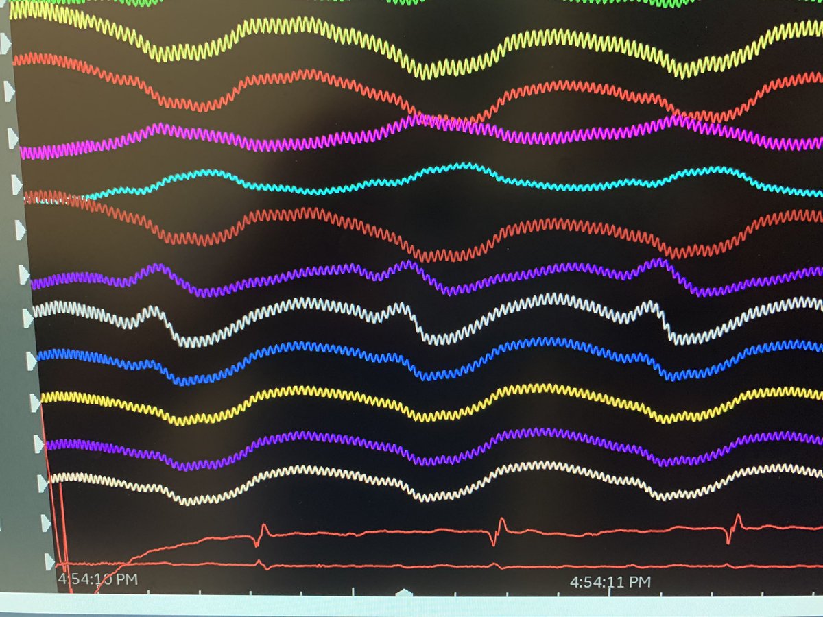 Anand (@anandshah_md) on Twitter photo Pretty nice way to start a weekend. Massive septal hypertrophy, lvad.
MCV alcohol, endo RF. Termination!@emoryheart <a href="/EvanBlankMD/">Evan Blank</a> <a href="/_shannonmillard/">SHANNON MILLARD</a> Pretty nice way to start a weekend. Massive septal hypertrophy, lvad.
MCV alcohol, endo RF. Termination!@emoryheart <a href="/EvanBlankMD/">Evan Blank</a> <a href="/_shannonmillard/">SHANNON MILLARD</a>