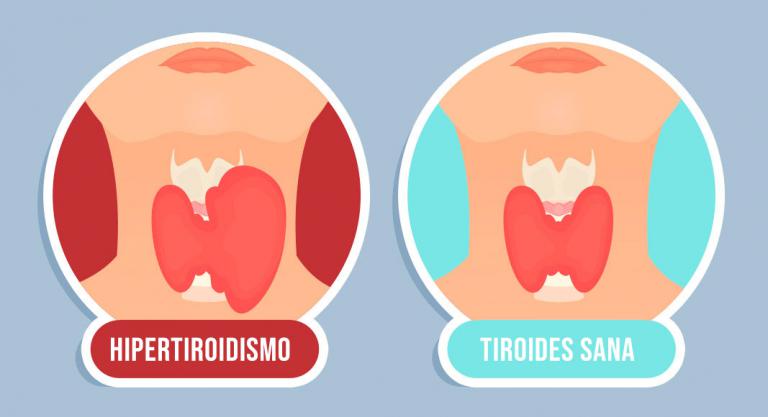 Hipertiroidismo y dolor de piernas