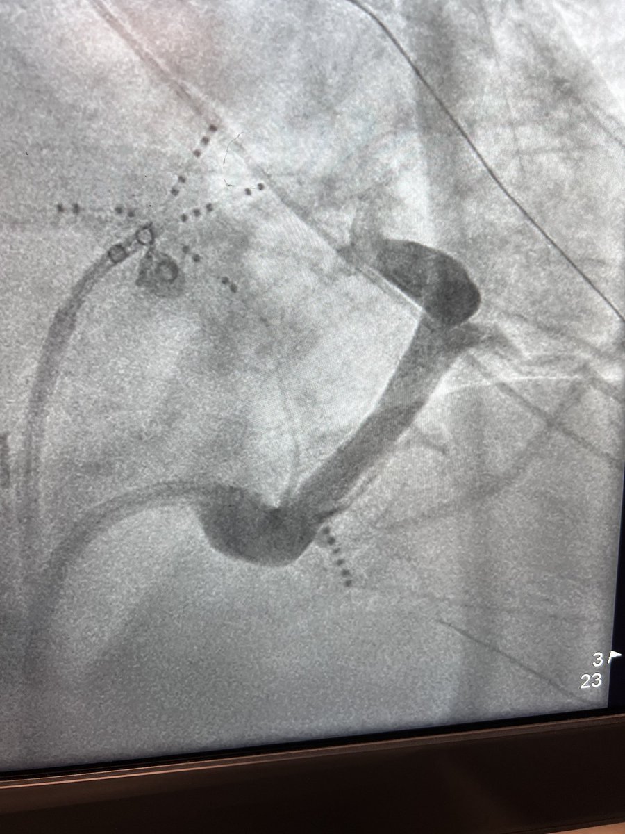 Ethanol ablation. Left PVs isolated