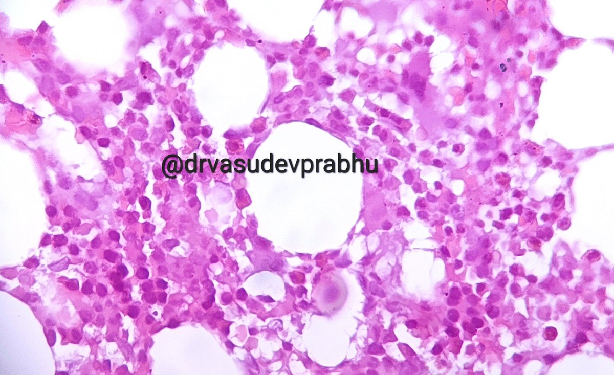 DrVasudevPrabhu's tweet photo. Spotter case
Elderly male with pathological # in femur. Marrow curretage from fracture site. #bonepathology #BSTPath #hematology #hemepath #PathTwitter #medtwitter @RagaviRamanan @RizviUroos @premcharles @ArvindKhanijo @DrApoorvaN1 https://t.co/jZlzFJUWu2