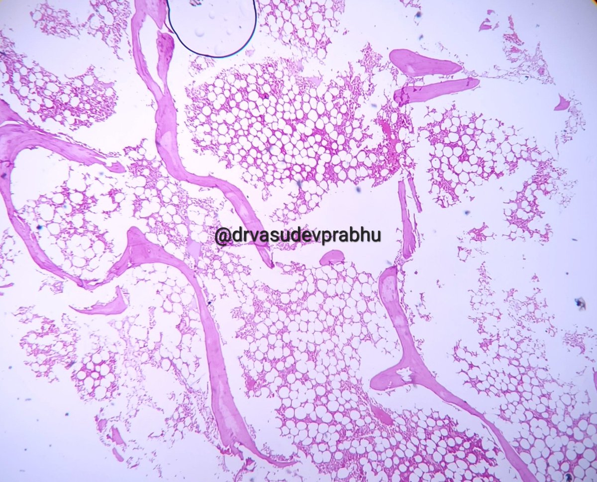 DrVasudevPrabhu's tweet photo. Spotter case
Elderly male with pathological # in femur. Marrow curretage from fracture site. #bonepathology #BSTPath #hematology #hemepath #PathTwitter #medtwitter @RagaviRamanan @RizviUroos @premcharles @ArvindKhanijo @DrApoorvaN1 https://t.co/jZlzFJUWu2