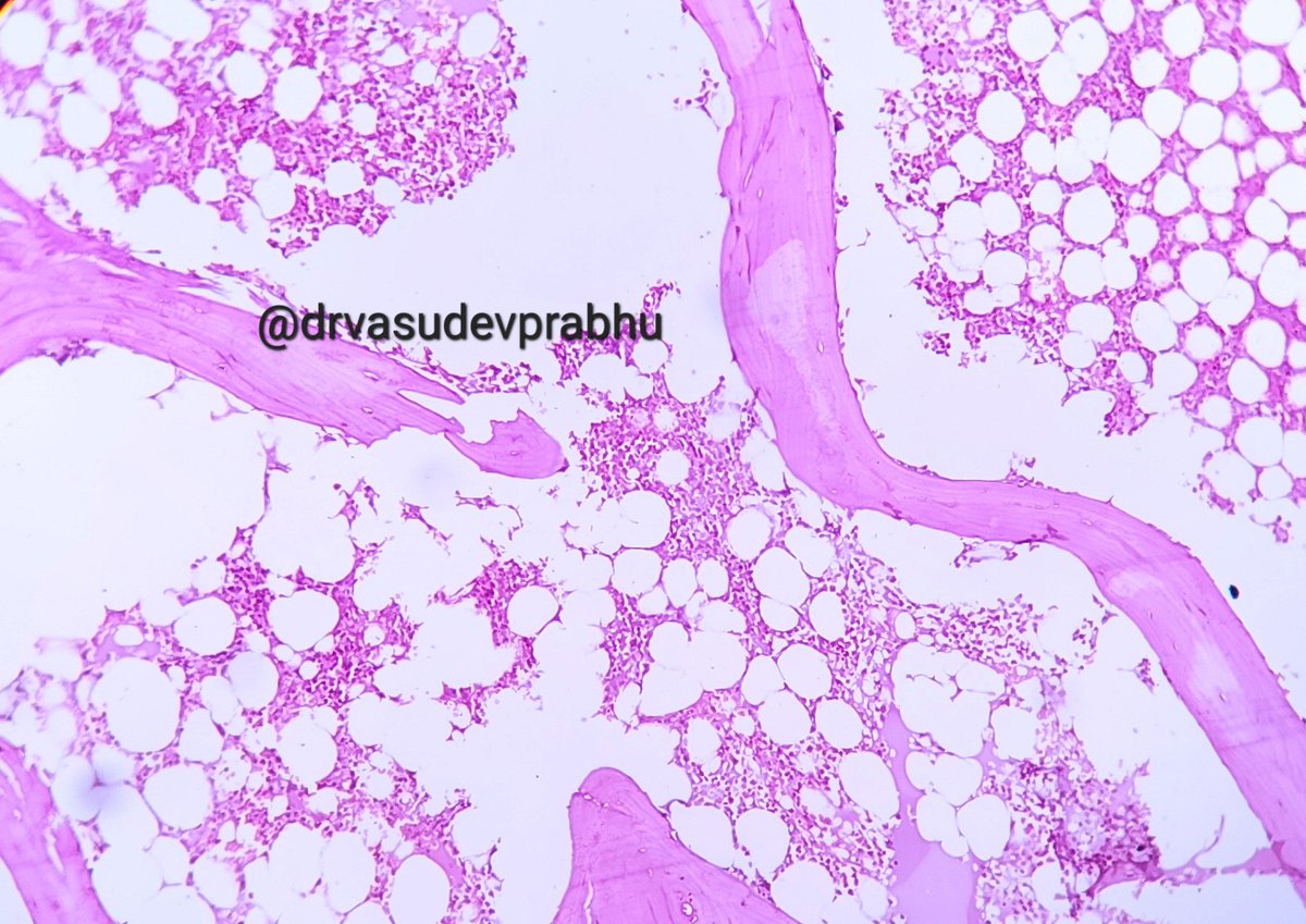 DrVasudevPrabhu's tweet photo. Spotter case
Elderly male with pathological # in femur. Marrow curretage from fracture site. #bonepathology #BSTPath #hematology #hemepath #PathTwitter #medtwitter @RagaviRamanan @RizviUroos @premcharles @ArvindKhanijo @DrApoorvaN1 https://t.co/jZlzFJUWu2
