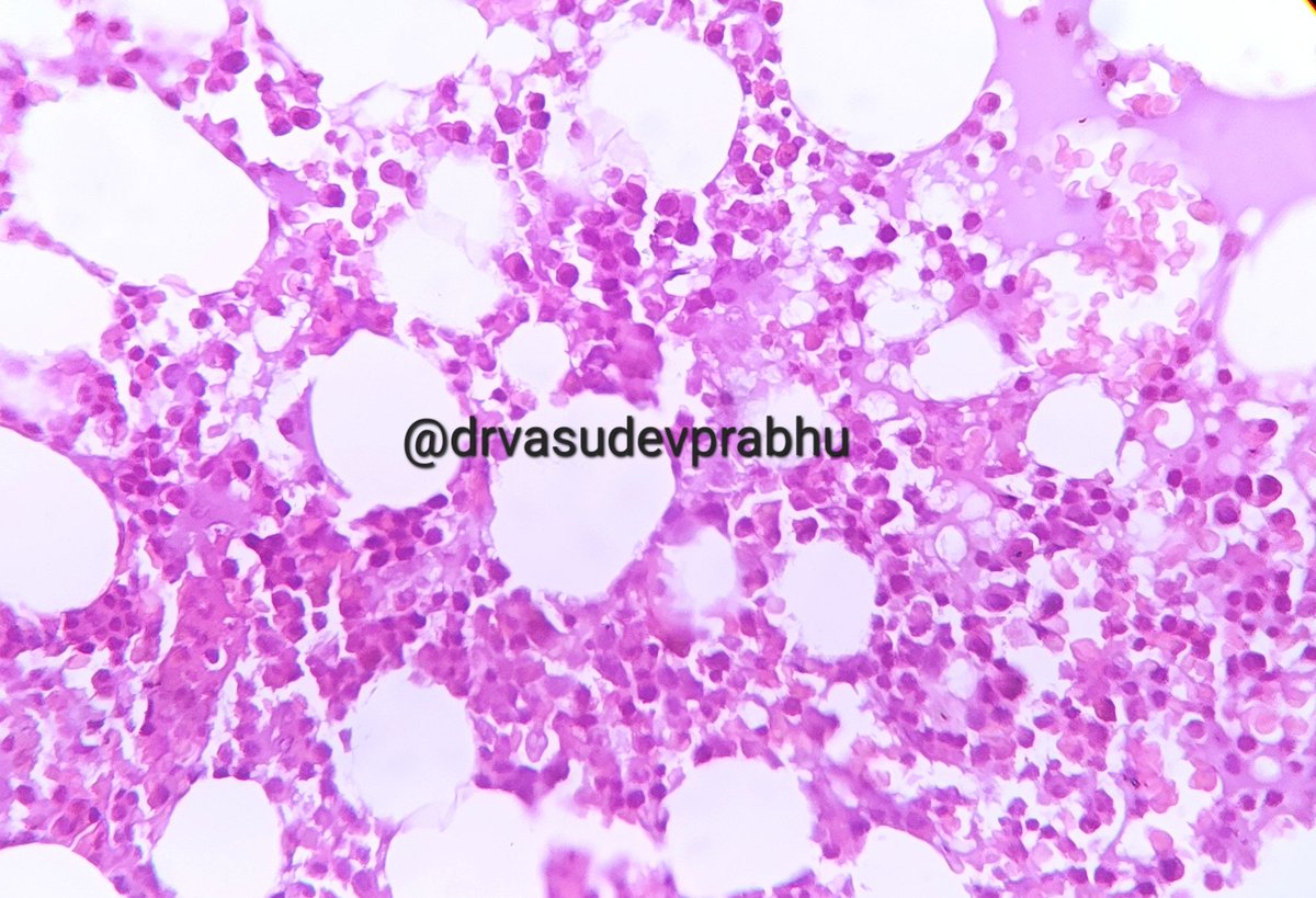 DrVasudevPrabhu's tweet photo. Spotter case
Elderly male with pathological # in femur. Marrow curretage from fracture site. #bonepathology #BSTPath #hematology #hemepath #PathTwitter #medtwitter @RagaviRamanan @RizviUroos @premcharles @ArvindKhanijo @DrApoorvaN1 https://t.co/jZlzFJUWu2