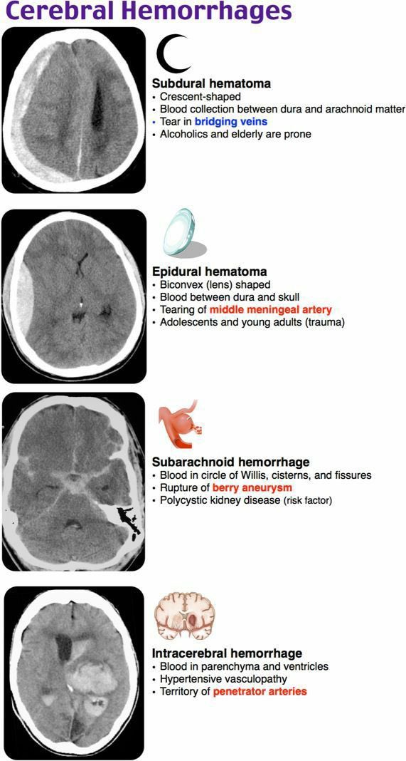 BrownJHM's tweet photo. Types of cerebral hemorrhages #BJHM #MedEd #Medtwitter #Neurotwitter #FOAMed https://t.co/MaWu9CDUZD