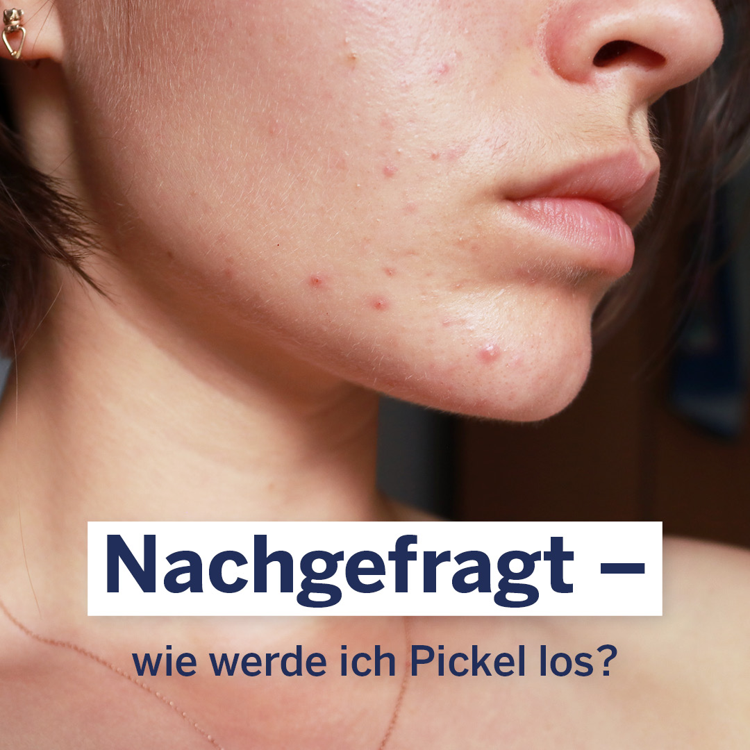 Zahnpasta auf #Pickel? Bitte nicht! 🙅‍♀️ Bei Pickeln gilt: Finger aus dem Gesicht. Setze stattdessen auf eine Reinigungs- und #Hautpflegeroutine, die auf deinen Hauttyp abgestimmt ist. Als SOS-Produkt können wir dir den Seborra Pickel-Akutroller empfehlen. 🆘 #DERMASENCE