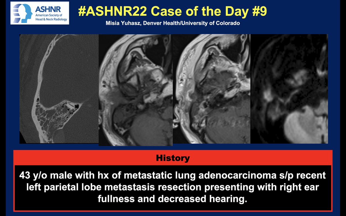 #ASHNR22 Case of the Day #9: Lung cancer w/ swelling & hearing loss. Dx? Thx Drs. Yuhasz 4 case! Answer w/ appropriate GIF only -- stay professional & don't spoil it! @AshokSrini15 @callyrobs @DShatzkes @CDP_Rad @rhwiggins @nakoontz @cmtomblinson @CMGlastonbury @tabby_kennedy