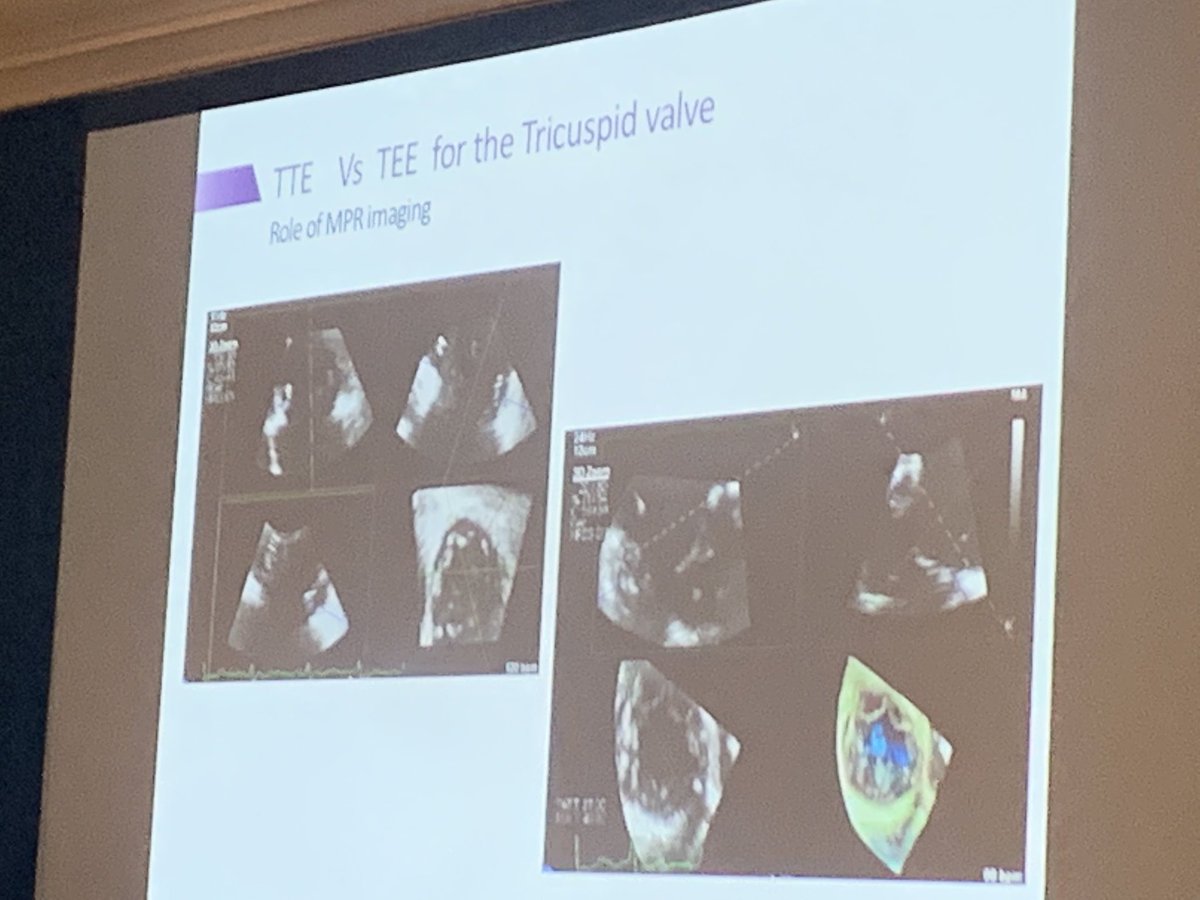 RigolinVera's tweet photo. Now time to learn about the TV at #EchoNU. @jyothyp shows that 3D of the TV is equal if not better with TTE compared to TEE. https://t.co/sYQ2o2NwkJ