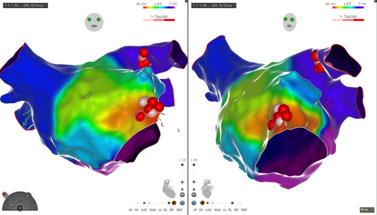 PAF re-do. Besides anterior LSPV reconnection, a very slow (600ms) focal AT from just below the LAA. Who’d more aggressive (PWI, LAAI, etc)? #EPeeps #Cardiotwitter #AFablation #cartov7 #biosensewebster #BSW @HospitalMaeDeus @socergs @SobracO @BiosenseWebster @sbc_cientifico