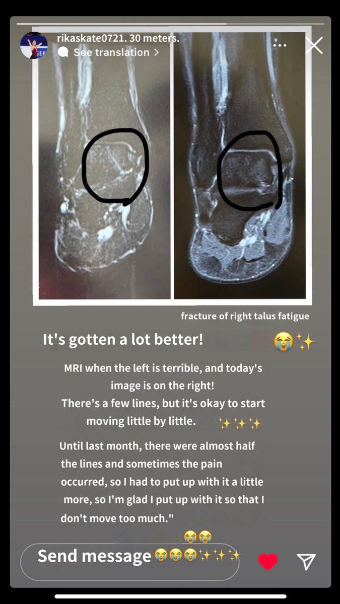 quadLz's tweet photo. Who thought the secret for bringing me back from hybernation would be this. Her injury was something that complicated because of the work she put on it, it’s in an uncomfortable place, but luckily she’s seeing the light out of the tunnel now, AS SHE’S SHOWN HERSELF https://t.co/usN6s0yPZL