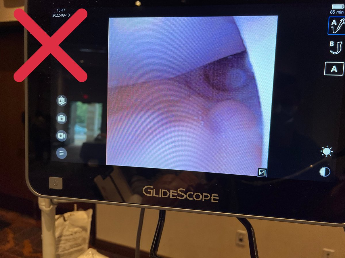 Bret Nelson (@bretpnelson) on Twitter photo For nasal intubations with flexible scope:
Loading the tube up on the scope means you have to battle the turbinates with the scope and again with the tube. ❌
Instead, preload the tube in the nose. Gives a clear path to cords, reduces contamination âś…
<a href="/TheAirwaySite/">theairwaysite</a>
#foamed For nasal intubations with flexible scope:
Loading the tube up on the scope means you have to battle the turbinates with the scope and again with the tube. ❌
Instead, preload the tube in the nose. Gives a clear path to cords, reduces contamination âś…
<a href="/TheAirwaySite/">theairwaysite</a>
#foamed