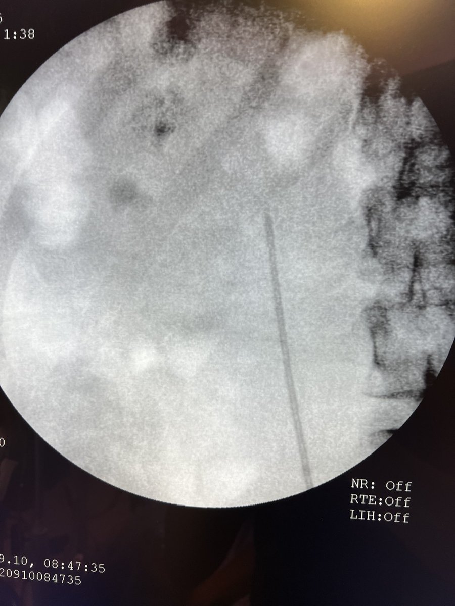 VcntKno's tweet photo. 🤓Saturday of #Miniperc 

#Storz 21Fr #Oneshot access sheath

@so_uro @Uroweb @colmexuro @CAU_URO @colmexuro https://t.co/OLpfPITNF7
