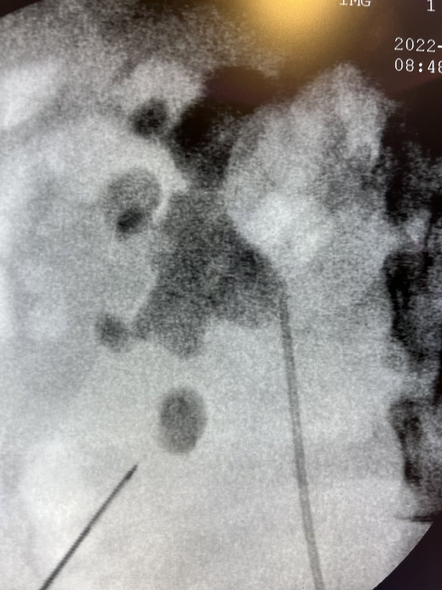 VcntKno's tweet photo. 🤓Saturday of #Miniperc 

#Storz 21Fr #Oneshot access sheath

@so_uro @Uroweb @colmexuro @CAU_URO @colmexuro https://t.co/OLpfPITNF7