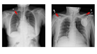 Radiology_AI's tweet photo. Fine-grained annotations overcame shortcut learning and enabled #DeepLearning models to identify lesion patterns https://t.co/9I4FtRIzKt @JackChan2021 @hkust #MachineLearning #ChestRad #AI https://t.co/kOQiVZ3yha