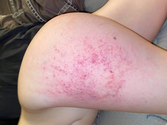 I was a bad girl last night 🥵🤭🫣 #spanking #nsfwtwt #bdsm #RETWEEET #badgirl #kinkytwitter #handprint<a href="/tag/spanking"class="tags">#spanking</a><a href="/tag/nsfwtwt"class="tags">#nsfwtwt</a><a href="/tag/bdsm"class="tags"><span>#bdsm</span></a><a href="/tag/badgirl"class="tags"><span>#badgirl</span></a><a href="/tag/retweeet"class="tags"><span>#retweeet</span></a><a href="/tag/handprint"class="tags"><span>#handprint</span></a><a href="/tag/kinkytwi"class="tags"><span>#kinkytwi</span></a>