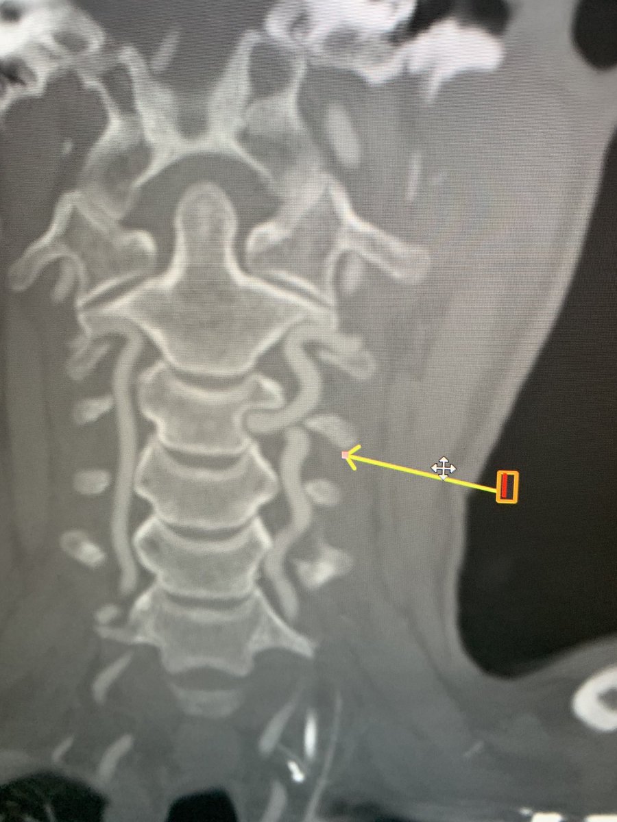 northwoods1980's tweet photo. Left vertebral artery loop. Just waiting for her transforaminal epidural injection😬 https://t.co/cqf9ZwkDrL