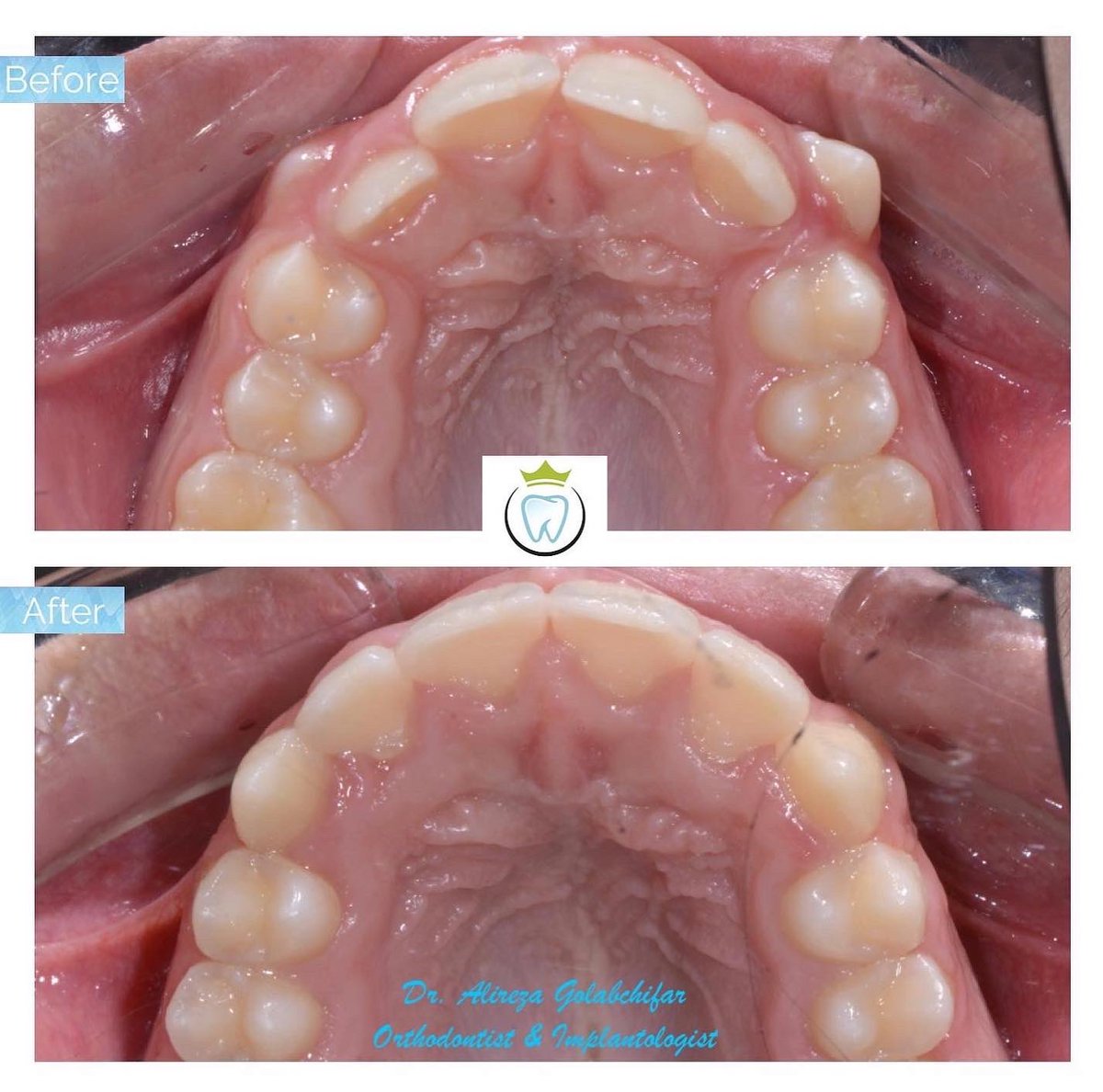 dentistry_king's tweet photo. Transformation!! From protruded upper canines, deep overbite and crowding to a beautiful healthy smile! No teeth removed.

#orthodontics #braces #smile #smiletransformation #cosmeticdentistry #orthosmile #orthosmiletoronto #dentistry #empresswalkdental #kingwestdentistry https://t.co/yOLfwr9FP0