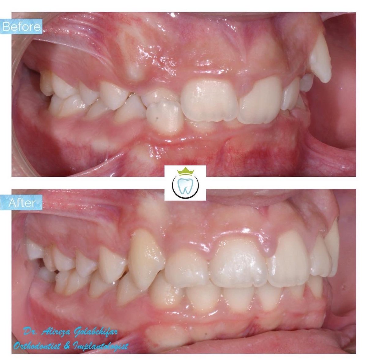 dentistry_king's tweet photo. Transformation!! From protruded upper canines, deep overbite and crowding to a beautiful healthy smile! No teeth removed.

#orthodontics #braces #smile #smiletransformation #cosmeticdentistry #orthosmile #orthosmiletoronto #dentistry #empresswalkdental #kingwestdentistry https://t.co/yOLfwr9FP0
