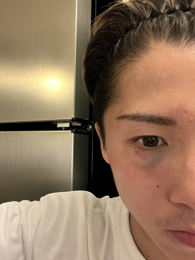 Monster 井上尚弥の目のアザはこうして出来た デラホーヤ 魚 のgloveびいき
