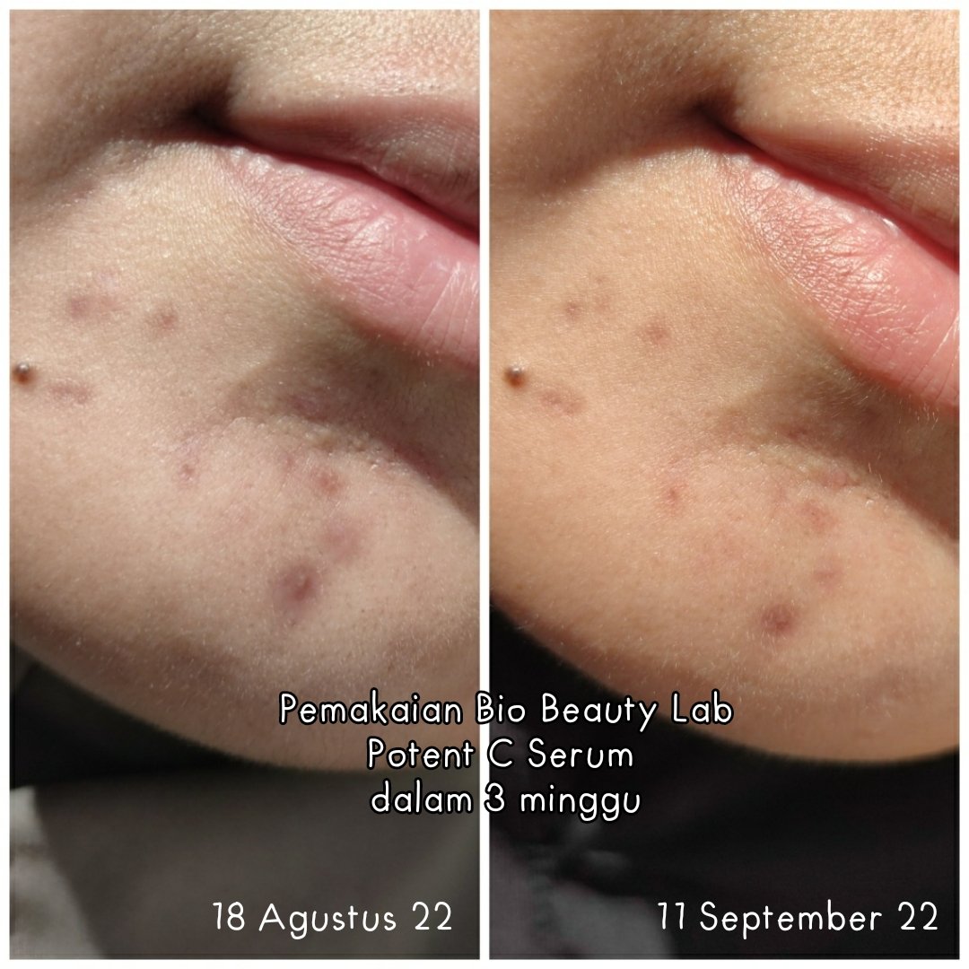 vellariani's tweet photo. Finally bisa share hasil pemakaian Potent C Serumnya @biobeautylab selama 3 minggu ini.  Jujur aku puas banget dengan hasilnya, karena bener-bener ngebantu menyamarkan bekas jerawat aku 🧡

#racuninskincare #biobeautylab #reviewnyamamam https://t.co/8epsjEZYfP