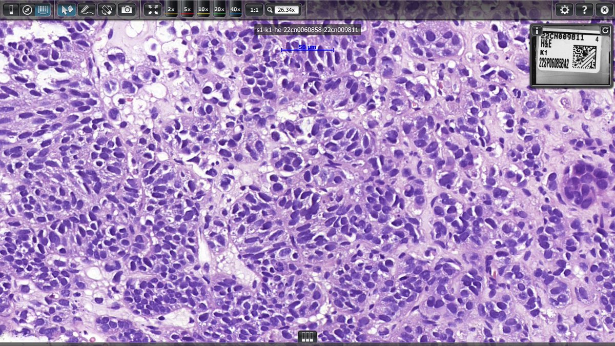 YarisDombrovsky's tweet photo. Hi everyone
Need some help with NE tumor again 🙂
I think, Andrew was right when he said, that GI Second Opinion Club #GISOC became NE Club at some point
So, liver met (occult primary)
It is NE, but is it NET G2/3 or LC-NEC? @IHC_guy @stephen_lagana @RAStandish https://t.co/WCWxDneug4