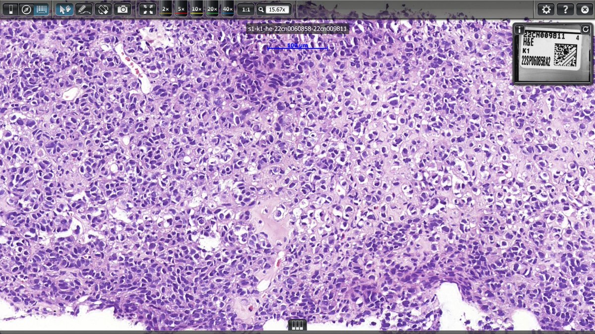 YarisDombrovsky's tweet photo. Hi everyone
Need some help with NE tumor again 🙂
I think, Andrew was right when he said, that GI Second Opinion Club #GISOC became NE Club at some point
So, liver met (occult primary)
It is NE, but is it NET G2/3 or LC-NEC? @IHC_guy @stephen_lagana @RAStandish https://t.co/WCWxDneug4
