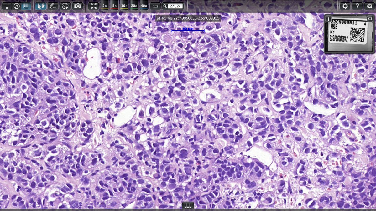 YarisDombrovsky's tweet photo. Hi everyone
Need some help with NE tumor again 🙂
I think, Andrew was right when he said, that GI Second Opinion Club #GISOC became NE Club at some point
So, liver met (occult primary)
It is NE, but is it NET G2/3 or LC-NEC? @IHC_guy @stephen_lagana @RAStandish https://t.co/WCWxDneug4