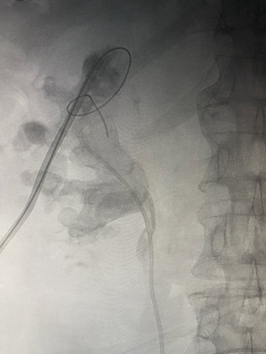 Adeebmsg's tweet image. وضع دعامه في الحالب لمريض يعاني من عدوى ( صدمه انتانية ) وحصوه مرجانيه كبيره.
DJ stent in septic patient with large staghorn calculus
@ksmcmedia