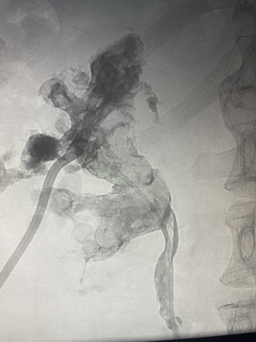Adeebmsg's tweet image. وضع دعامه في الحالب لمريض يعاني من عدوى ( صدمه انتانية ) وحصوه مرجانيه كبيره.
DJ stent in septic patient with large staghorn calculus
@ksmcmedia