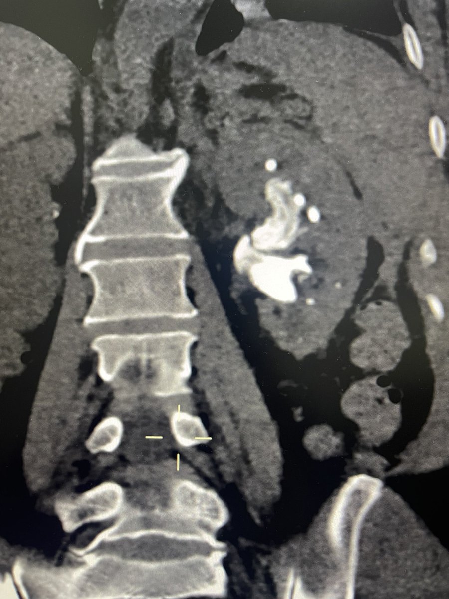Adeebmsg's tweet image. وضع دعامه في الحالب لمريض يعاني من عدوى ( صدمه انتانية ) وحصوه مرجانيه كبيره.
DJ stent in septic patient with large staghorn calculus
@ksmcmedia