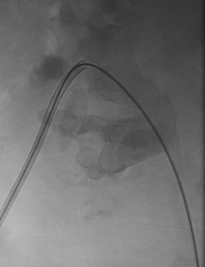 Adeebmsg's tweet image. وضع دعامه في الحالب لمريض يعاني من عدوى ( صدمه انتانية ) وحصوه مرجانيه كبيره.
DJ stent in septic patient with large staghorn calculus
@ksmcmedia
