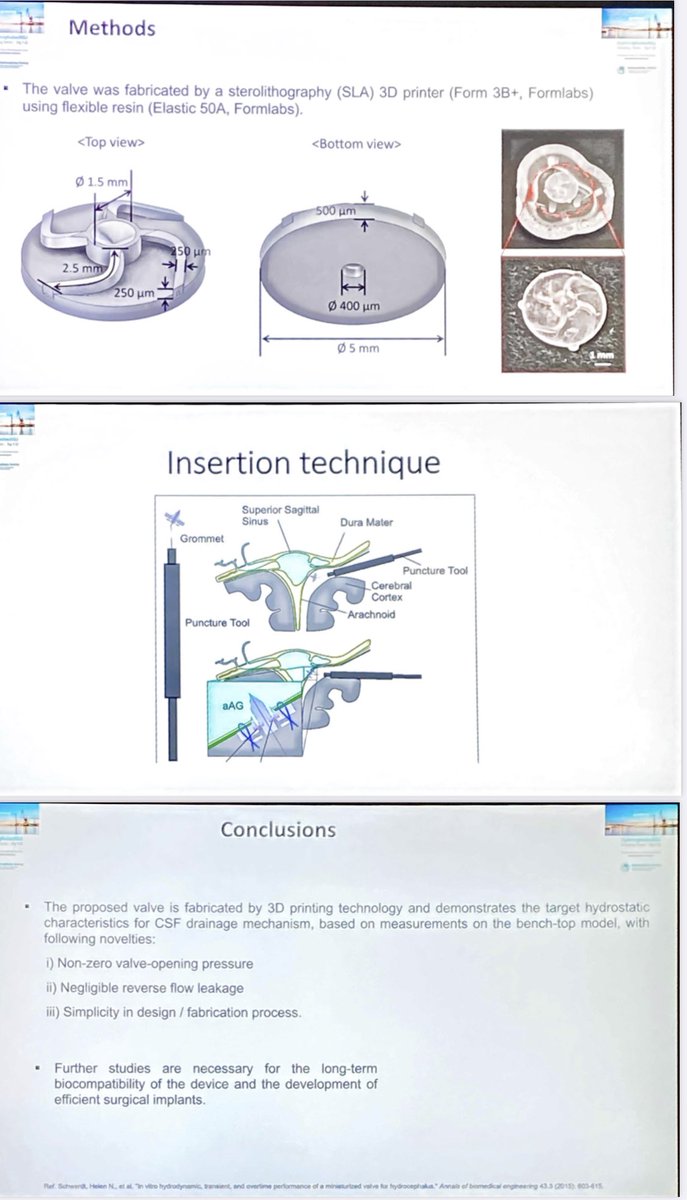 3D-printed catheterless sinus shunts - at laboratory stage &amp; some technical challenges remain - but an innovative idea for treating communicating #hydrocephalus 

#hydrocephalus2022