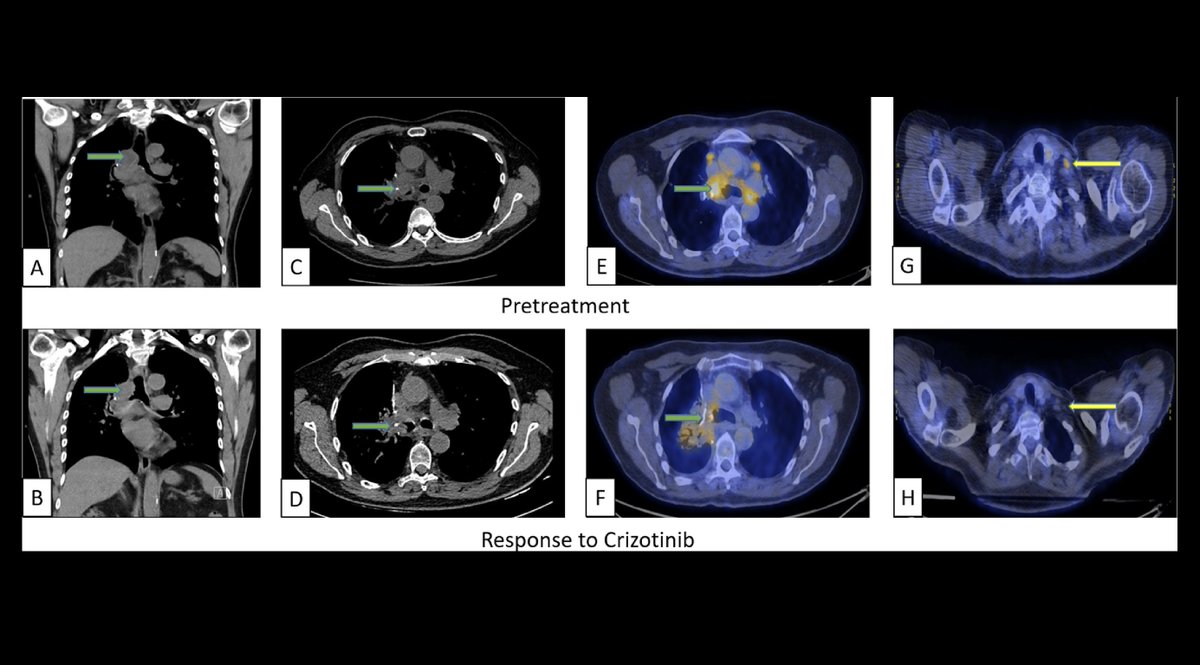 A case report describing ALK-rearranged NSCLC transforming to an ALK-rearranged inflammatory myofibroblastic tumor (IMT) upon recurrence. A common origin was suggested based on molecular profiling. A response was seen with ALK-TKI therapy. #LCSM More: bit.ly/3DgBDIv