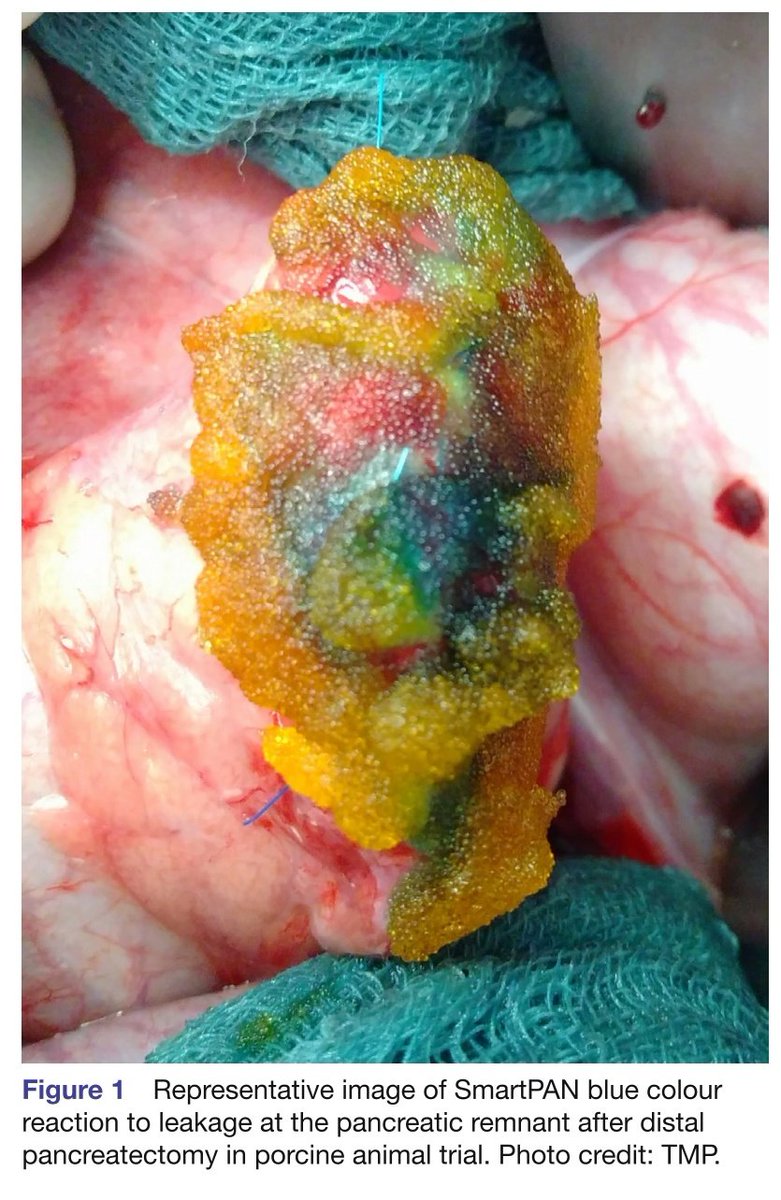 TeamSurgery247's tweet photo. Intraoperative visualisation of  pancreatic leakage (ViP): study protocol  for an IDEAL Stage I Post Market  Clinical Study #some4surgery https://t.co/3Kkec9JTB1