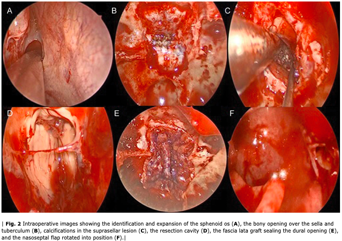 NASBSorg's tweet photo. #nsgy #OpVid from @BradZachariaMD demonstrating the Expanded #Endoscopic Endonasal Resection of Retrochiasmatic Craniopharyngioma #neurosurgery #education #approaches #neuroonc
@jdavanzomd @NGoyalMD 
Text: https://t.co/Skfwatp5XB
Video: https://t.co/5vv1Tg1pVQ https://t.co/YH66aYDh1z