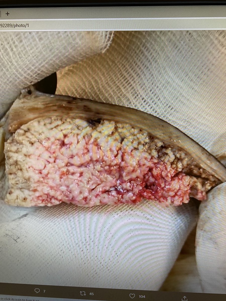 slusagar's tweet image. #GYNpath #LPpath uterus:

Cotyledonoid dissecting leiomyoma