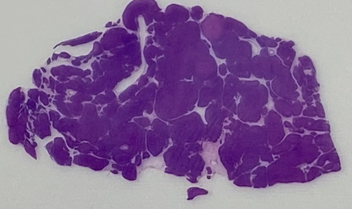 slusagar's tweet image. #GYNpath #LPpath uterus:

Cotyledonoid dissecting leiomyoma