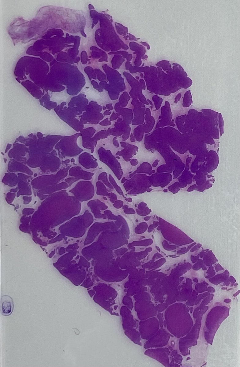 slusagar's tweet image. #GYNpath #LPpath uterus:

Cotyledonoid dissecting leiomyoma