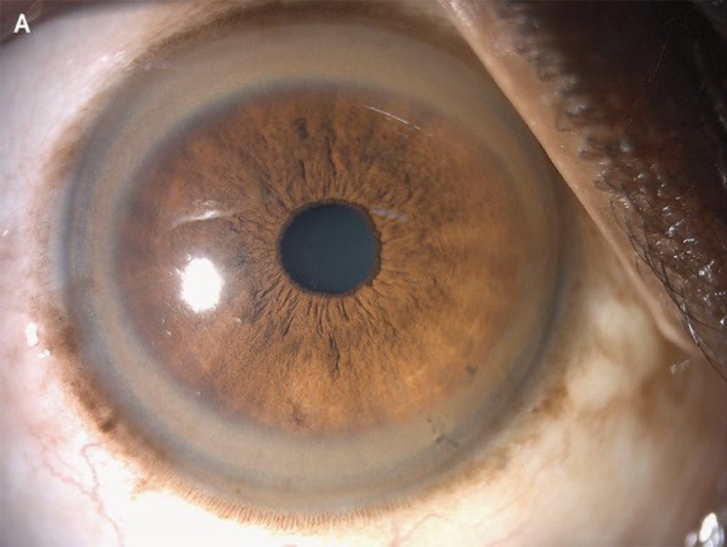 AvrahamCooperMD's tweet image. A patient presents with a distended abdomen. His eyes look like this. What’s the diagnosis? 

#MedTwitter