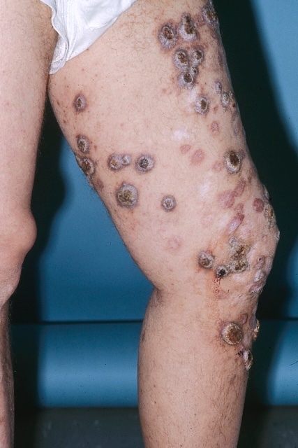 BrownJHM's tweet photo. A 50 year old farmer came with fever, cough, night sweats and rash after recently being in Arizona. No improvement despite being on antibiotics. Culture revealed spherules with endospores. What is the diagnosis and treatment? #IDtwitter #Medtwitter https://t.co/hMxLjDWjPs