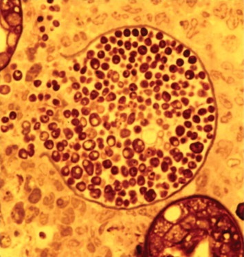 BrownJHM's tweet photo. A 50 year old farmer came with fever, cough, night sweats and rash after recently being in Arizona. No improvement despite being on antibiotics. Culture revealed spherules with endospores. What is the diagnosis and treatment? #IDtwitter #Medtwitter https://t.co/hMxLjDWjPs