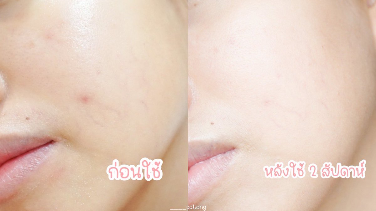____patong's tweet photo. เซรั่มลดจุดด่างดำฝังลึกตัวใหม่ของยูเซอรินที่มีสารไทอามิดอลช่วยยับยั้งเม็ดสีตั้งแต่ต้นตอคือปังมากก เห็นผลจริง ใช้มา 2 วีคแล้วรอยดำจากสิวจางลงไปเยอะมากๆ🥹 แถมเขายังช่วยให้รู้สึกผิวดูโกลว์ กระจ่างใส ชุ่มชื้นขึ้นด้วยเพราะสูตรมี Hya + Glycerin 10% เนื้อดี ซึมไว ควรมี!! #ใช้ดีบอกต่อ https://t.co/IcUUoJXScC