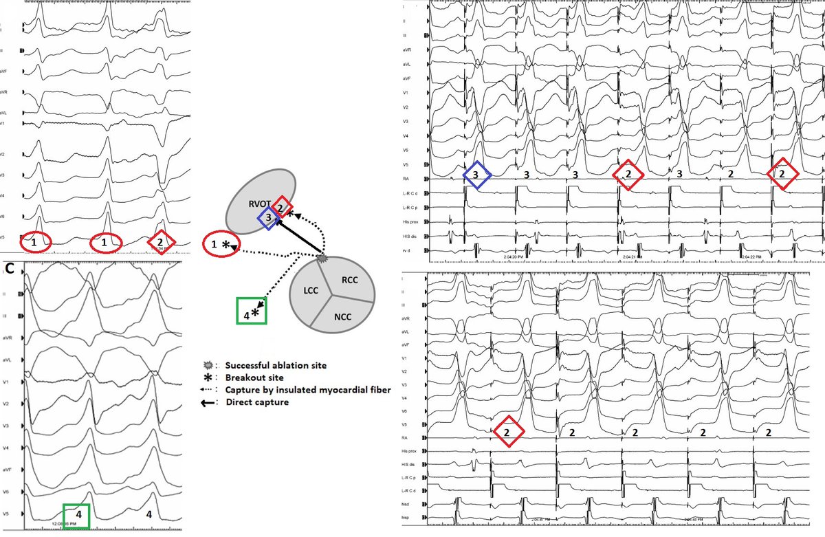 Yuksek Ihtisas Arrhythmia- Ankara City Hospital (@ach_epteam) on Twitter photo Preferential conduction with LOW and HIGH ⚡ pace mapping
<a href="/cardiogenius77/">Cardiogenius77</a> <a href="/Mkara_EP/">Mkara</a> <a href="/ElifhandeMD/">Elif Hande Özcan Çetin</a> <a href="/AhmetKorkmaz07A/">Ahmet</a> <a href="/ozcanozeke/">Özcan Özeke</a> <a href="/prof_serkan_cay/">Prof Dr Serkan Cay</a> <a href="/drfiratozcan/">Fırat Özcan</a> <a href="/DursunAras2/">Dursun Aras, Professor</a> <a href="/topaloglu_prof/">Serkan Topaloglu, MD</a> <a href="/OYousaku/">Okubo Yousaku</a> <a href="/ya4643su/">Yasuo Okumura@EP大学アブレーション学部最高顧問</a> <a href="/drabdlkdruslu/">Abdulkadir Uslu</a> <a href="/NCalambur/">narasimhan Calambur</a> <a href="/MoussaMansour10/">Moussa Mansour</a> bit.ly/3qdcI2l <a href="/JICRM/">JICRM</a> Preferential conduction with LOW and HIGH ⚡ pace mapping
<a href="/cardiogenius77/">Cardiogenius77</a> <a href="/Mkara_EP/">Mkara</a> <a href="/ElifhandeMD/">Elif Hande Özcan Çetin</a> <a href="/AhmetKorkmaz07A/">Ahmet</a> <a href="/ozcanozeke/">Özcan Özeke</a> <a href="/prof_serkan_cay/">Prof Dr Serkan Cay</a> <a href="/drfiratozcan/">Fırat Özcan</a> <a href="/DursunAras2/">Dursun Aras, Professor</a> <a href="/topaloglu_prof/">Serkan Topaloglu, MD</a> <a href="/OYousaku/">Okubo Yousaku</a> <a href="/ya4643su/">Yasuo Okumura@EP大学アブレーション学部最高顧問</a> <a href="/drabdlkdruslu/">Abdulkadir Uslu</a> <a href="/NCalambur/">narasimhan Calambur</a> <a href="/MoussaMansour10/">Moussa Mansour</a> bit.ly/3qdcI2l <a href="/JICRM/">JICRM</a>